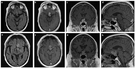 Pituitary Tumor Mri