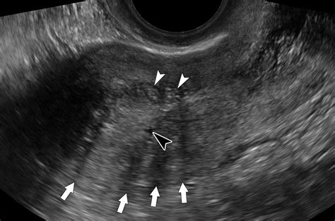 Transvaginal US of Endometriosis: Looking Beyond the Endometrioma with ...