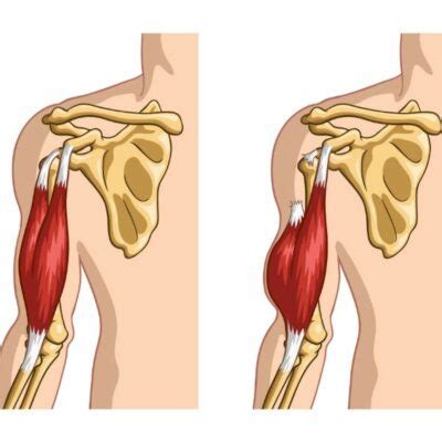 Biceps Tendon Tear and Injury | Shoulder Specialist | South Windsor ...