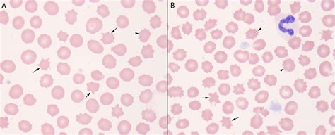 Acanthocytes versus Echinocytes | eClinpath