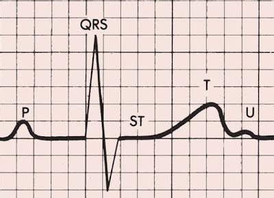 ECG T wave changes and interpretation