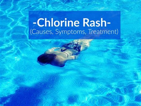 Chlorine Rash (Causes, Symptoms, Treatment) - The Healthy Apron