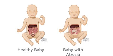 Intestinal Atresia: Detection & Management