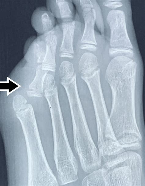 A Rare Case of Neglected Fifth Metatarsophalangeal Joint Dislocation ...