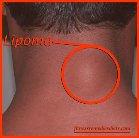 What Is A Lipoma? Lipoma Treatment. How To Remove A Lipoma? | Fitness Remedies Diets