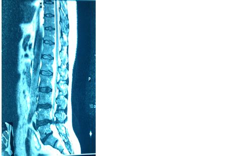The Outcome of Minimally Invasive Discectomy in Single Level Lumbar Disc Prolapse