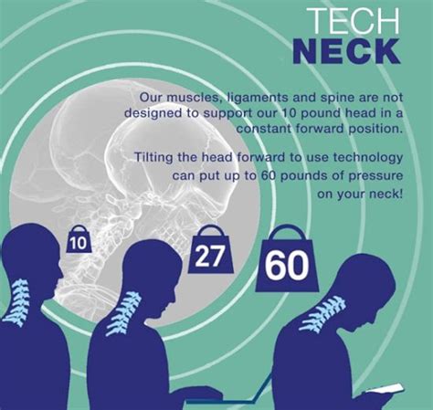 Tech Neck Symptoms and How to Treat Them