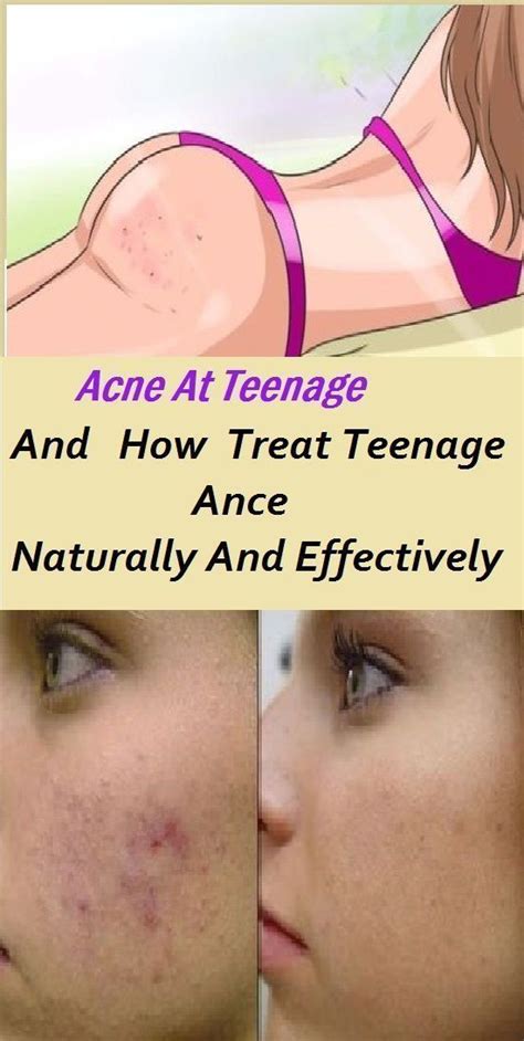 Teenage Acne: How To Treat It Naturally And Effectively | Teenage acne ...