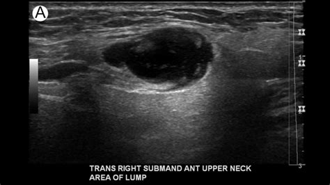 Lymphadenitis and Lymphadenopathy - Internet Book Of MSK Ultrasound