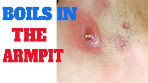 Boil in armpit | Symptoms of boil in armpit | Arm pit pus | Underarm ...