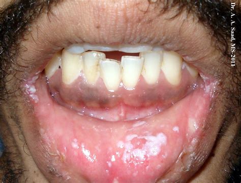 Candidiasis (oral) - dermRounds Dermatology Network