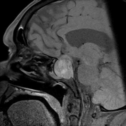 Pituitary apoplexy | Image | Radiopaedia.org