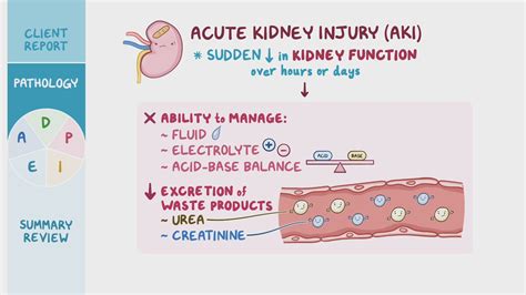 Acute kidney injury (AKI): Nursing Process (ADPIE) - Osmosis