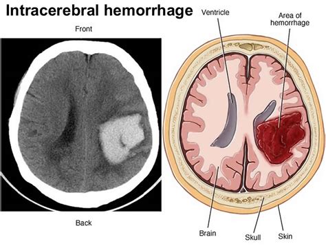 Intracerebral hemorrhage causes, symptoms, diagnosis, treatment & recovery