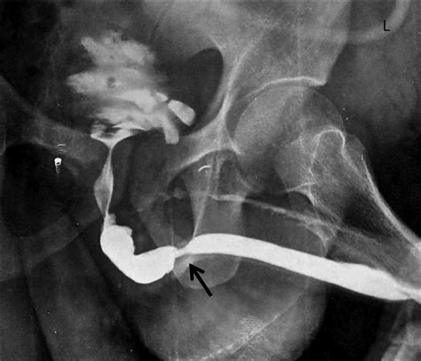 Retrograde urethrogram showing bulbar urethral stricture (Case 2) | Download Scientific Diagram