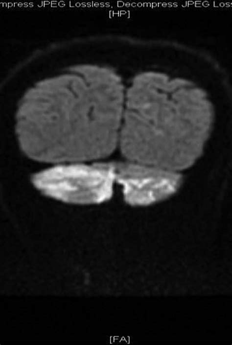 MRI diffusion imaging on day 3. | Download Scientific Diagram