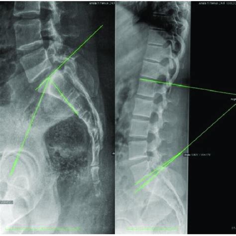 Complications of OLIF and MI-TLIF studies. | Download Scientific Diagram