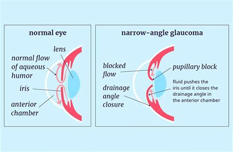 Closed Angle Glaucoma Vs Open Angle