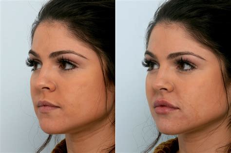 Juvederm Injectable Gel Photos | Houston, Tx | Patient 10755