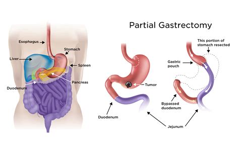 Gastric Cancer Treatment | My Doctor Online