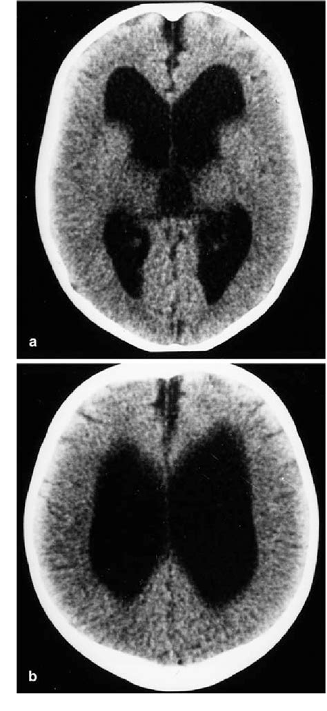 Figure 3 from MRI findings of hypoxic cortical laminar necrosis in a child with hemolytic anemia ...