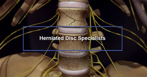 Herniated Disc S1 - S2 Symptoms & Treatment - Dr. Kevin Pauza, The Discseel® Procedure inventor