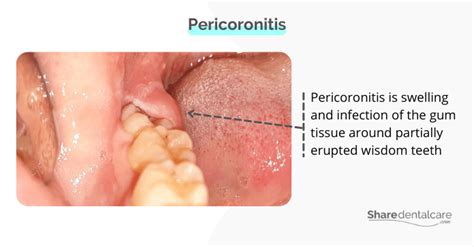 Pericoronitis Treatment at Home: How to Relieve Symptoms - Share Dental Care