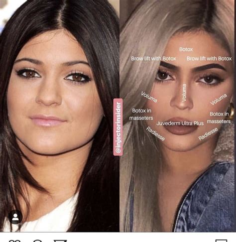 Pin by Victoria Turner on Medical spa | Celebrity plastic surgery ...