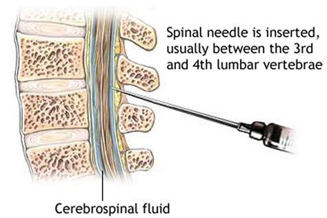 Lumbar Puncture Procedure - Position & Lumbar Puncture Side Effects