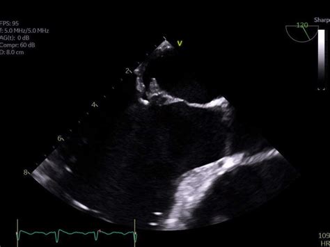 Cureus | An Unexpected Outcome of Streptococcus sanguinis Endocarditis ...