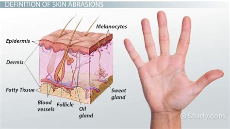 What Is Skin Abrasion? - Definition & Treatment - Lesson | Study.com