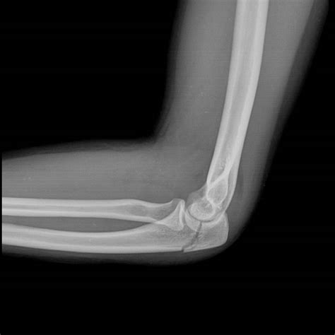 Olecranon Fractures – Core EM