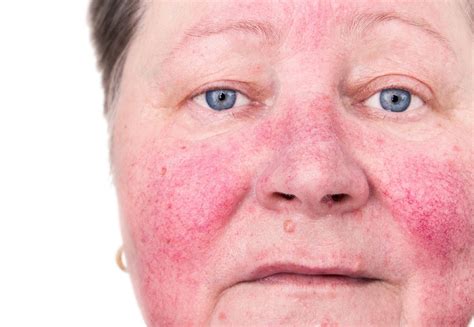 Rosacea Rash On Face