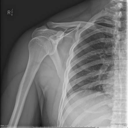 Scapular fracture | Image | Radiopaedia.org