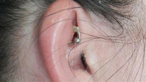 Infected Ear Cartilage Piercing