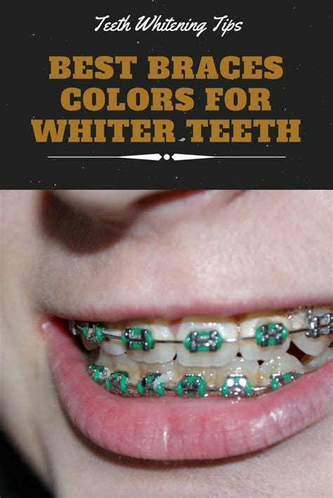 How To Get Naturally White Teeth With Braces - How To Whiten Your Teeth Without Damaging Them ...