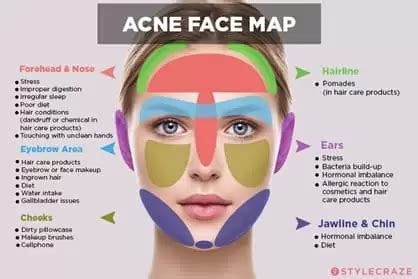 Cheek Acne: What It Means & How To Treat It | Pandia Health