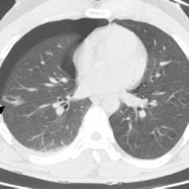 Macroscopic specimen: wedge resection of the lateral segment of the ...