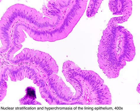 Pathology Outlines - Villous adenoma