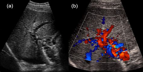 Portal Vein Thrombosis - The American Journal of Medicine