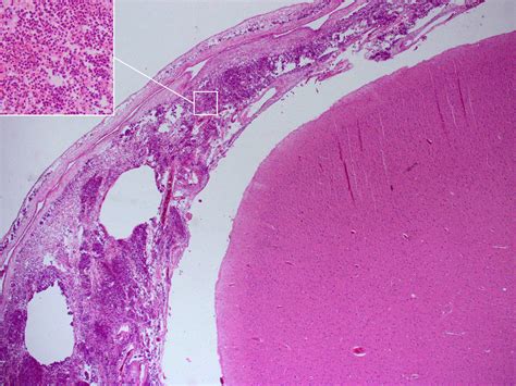 File:Meningitis Histopathology.jpg - Wikipedia