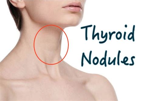 All-Natural Remedies for Thyroid Cystic Nodules — HealthDigezt.com