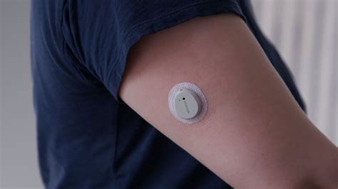 The rise of continuous glucose monitors