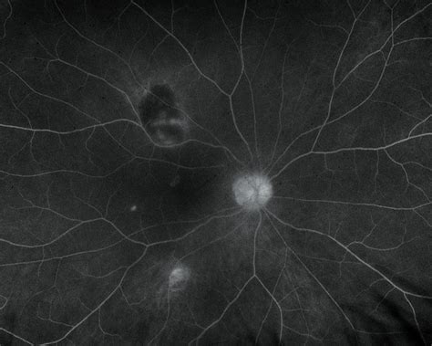 Fluorescein Angiography: What It Is and What To Expect