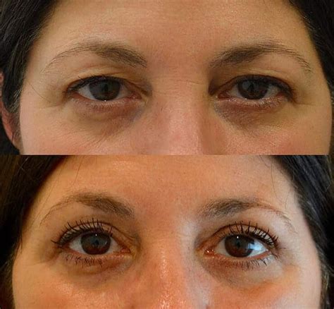 Upper Eyelid Surgery Blepharoplasty Before & After Photos - FRESH FACE + EYE