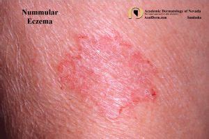 Nummular Eczema - Academic Dermatology of Nevada