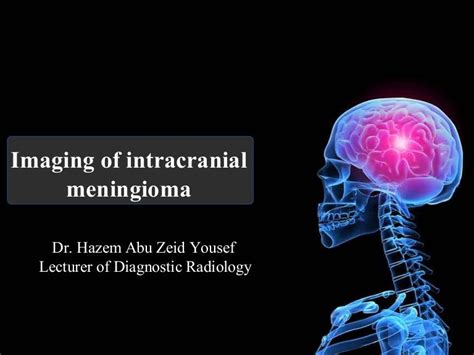 Imaging of Intracranial Meningioma