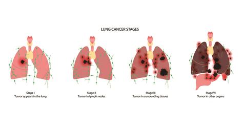 Stages Of Lung Cancer