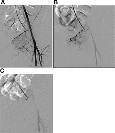 -A) Selective left external iliac artery angiogram showing the high... | Download Scientific Diagram