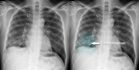 Chest X Ray Consolidation